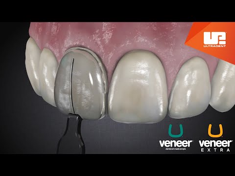 Ultradent - Uveneer Kit