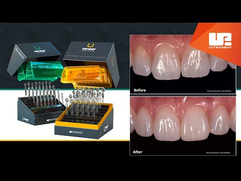 Ultradent - Uveneer Kit